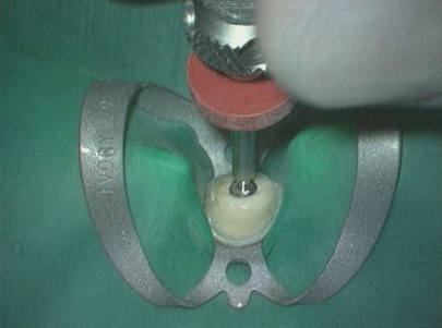 post and core removal
