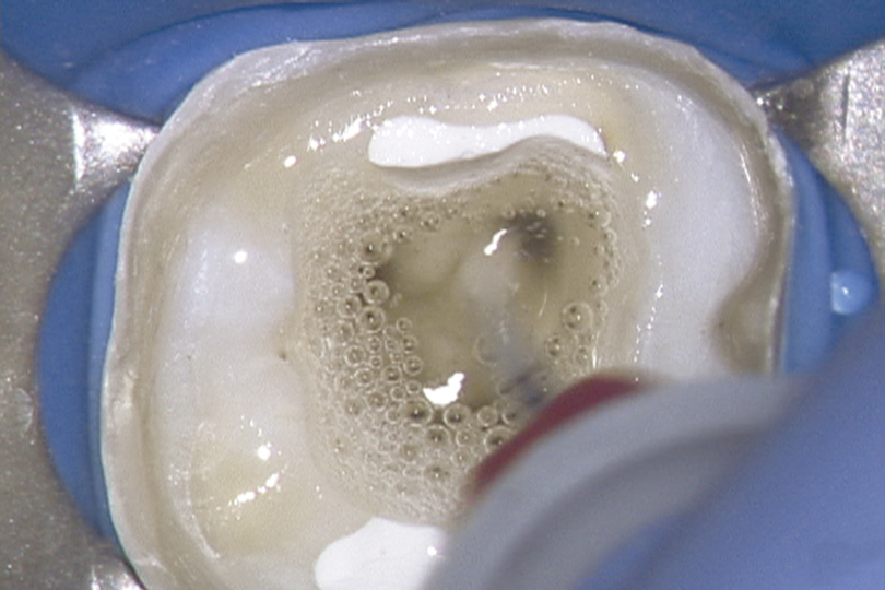 EndoActivator System Advanced Endodontics